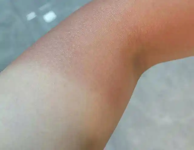 送外卖胳膊被晒黑(第一天跑外卖胳膊晒红了)(2)