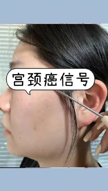 宫颈癌变看脸就知道,2种表现,别大意