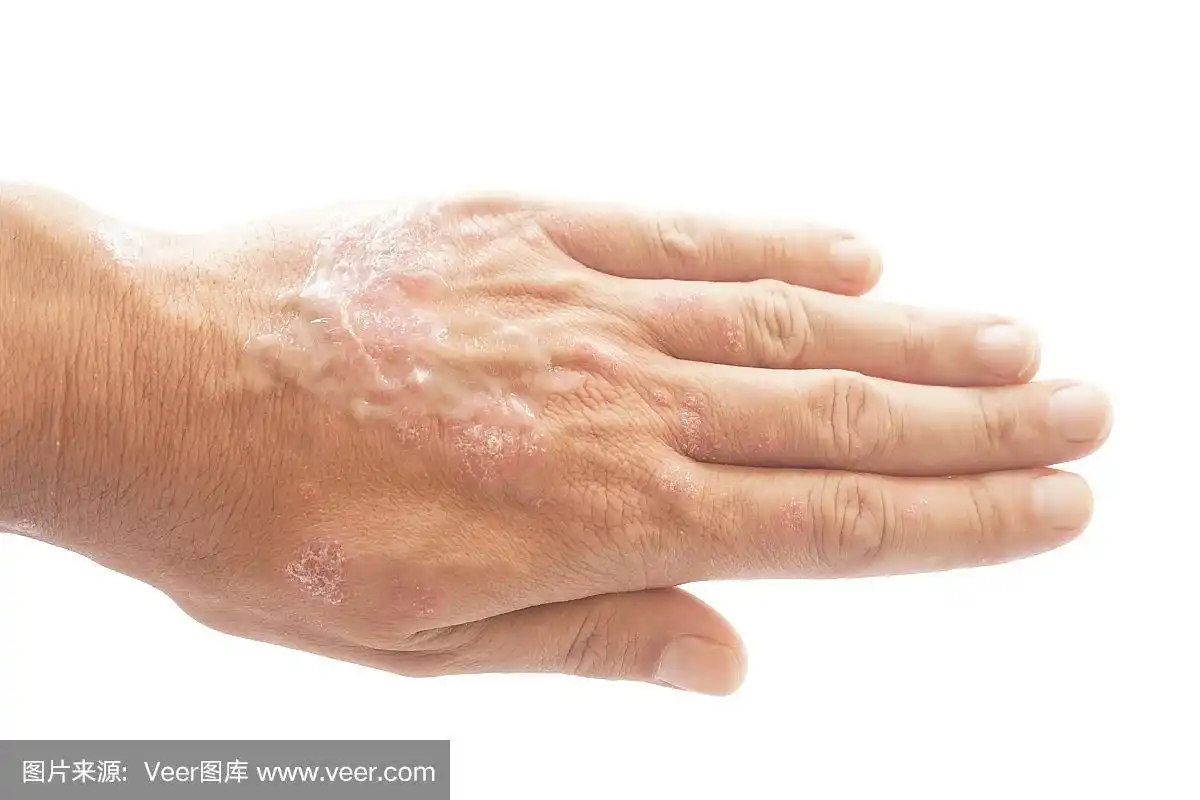 男人手上的寻常型银屑病和真菌,皮肤上有斑块,皮疹和斑块,孤立在白色