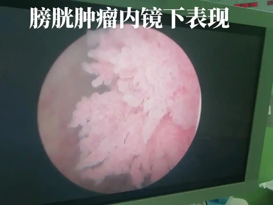 近段时间做的部分膀胱肿瘤, - 抖音