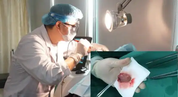 鼻息肉怎么治疗?