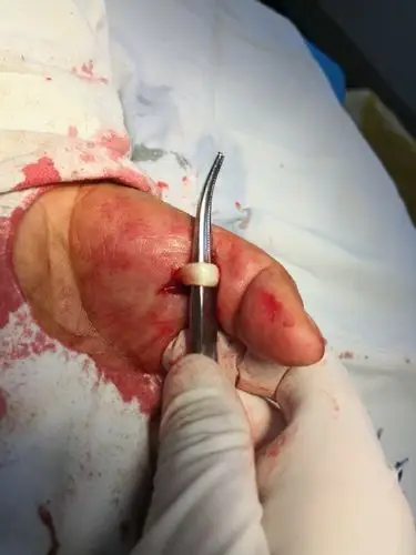 大拇指为什么伸不直了?――狭窄性腱鞘炎. - 好大夫在线