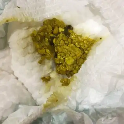 宝宝刚出生3天 拉屎这个样子 黄色颗粒状 请问为什麼啊 急