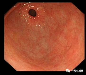 萎缩性胃炎图集