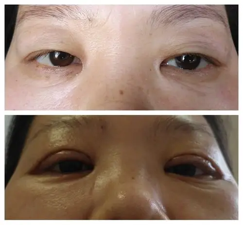 泪腺脱垂(术前,术后对比)
