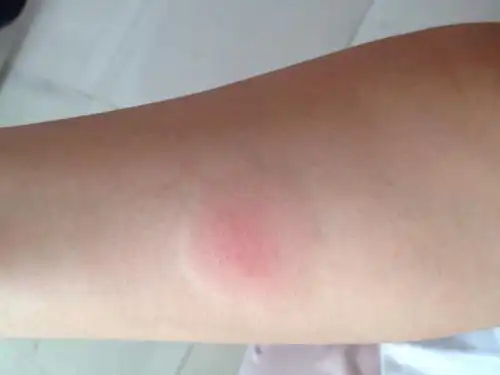 我是肺结核吗?会不会传染家里人?需要治疗吗?但是之前做过