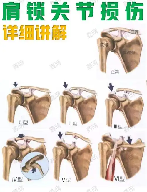 肩锁关节损伤内容较为详细