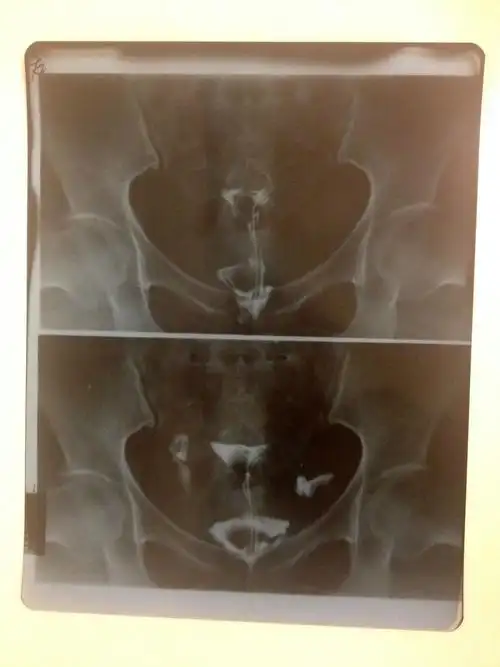 输卵管伞端粘连远端堵塞如何治疗