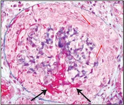 肾内病理图解:新月体性肾小球肾炎