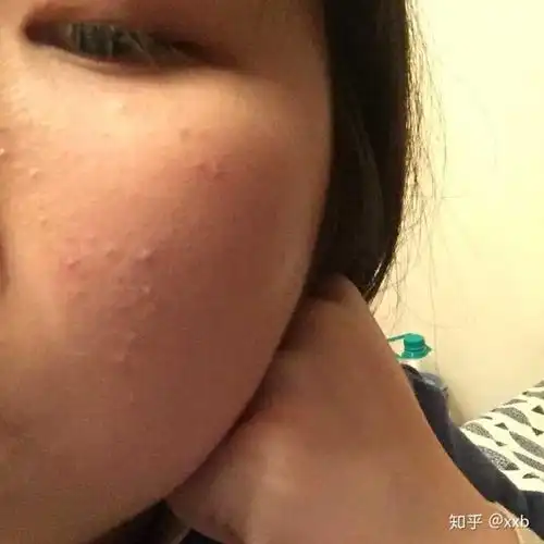 dw粉底液真的会闷痘吗?