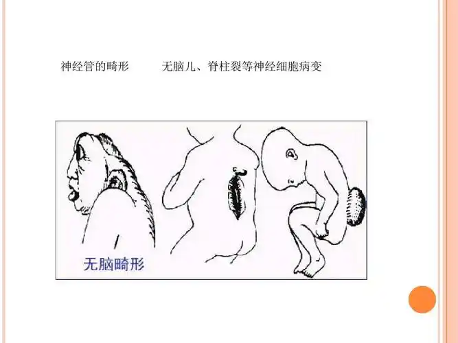 神经管的畸形 无脑儿,脊柱裂等神经细胞病变