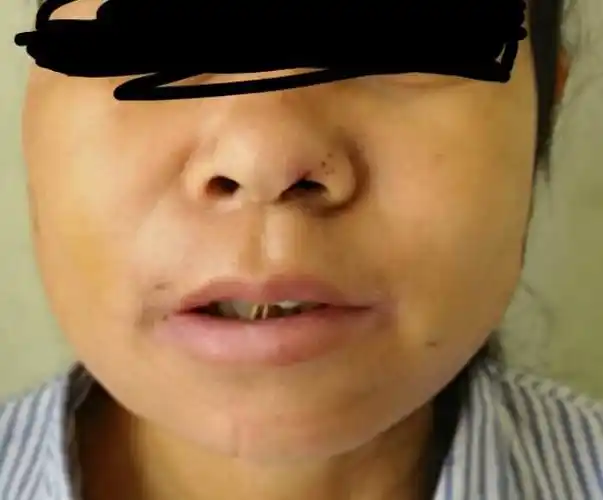 一例髁突肿瘤导致的下颌严重偏斜的手术治疗原创