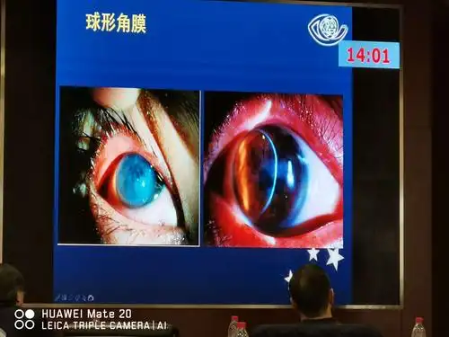 圆锥角膜的诊断和治疗(史伟云)