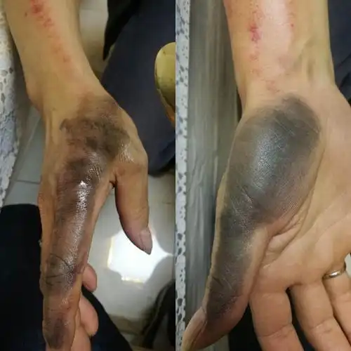 天鉴之道——肛裂