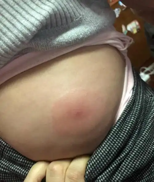 求助孩子屁股上这发的是什么他说有点疼有点痒