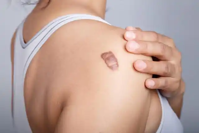 怎样抑制疤痕增生疤痕增生的护理治疗方法