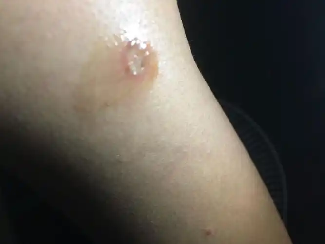 这样的烟疤 会留痕迹吗 刚刚不小心烫的 怎么去掉