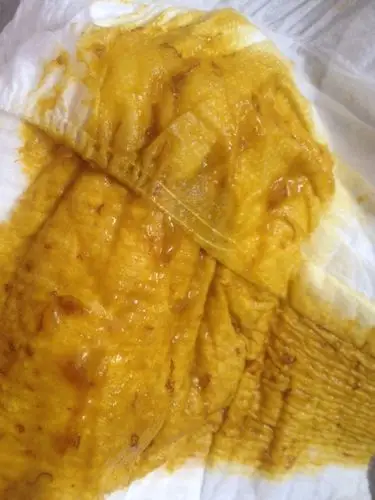 这几天宝宝很闹腾,今天大便的时候发现便便有点红血丝类的东东杏