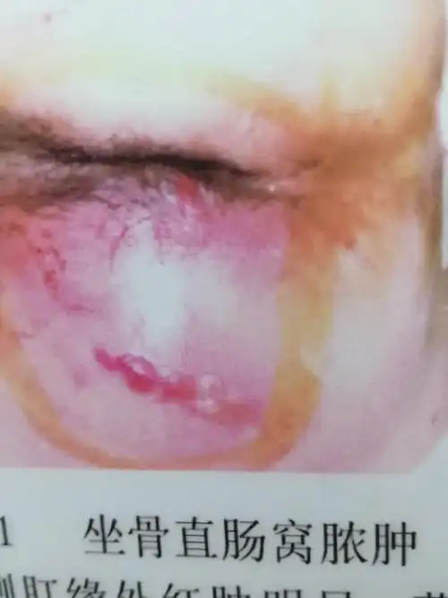 写美篇三,肛肠:内痔,外痔,混合痔,肛裂,肛瘘,肛周脓肿,肛门瘙痒症,肛