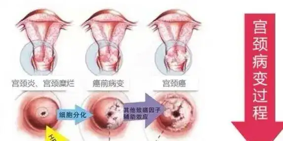 也许你觉得宫颈癌离自己很遥远,其实它就在你的身边,别让宫颈癌的三
