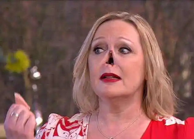 英国女士有一盒子假鼻子挑选佩戴只因她罹患疾病失去原装款