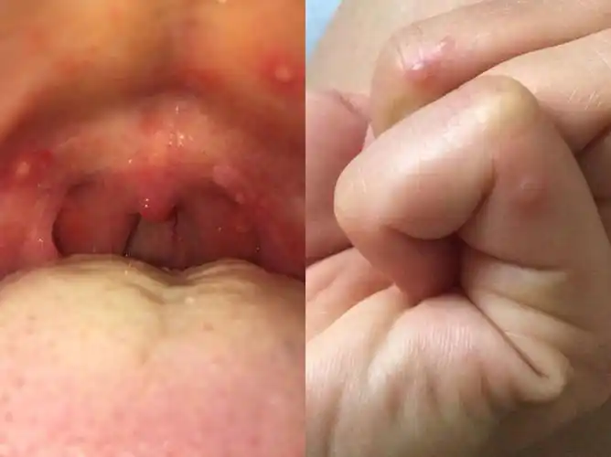 手足口高峰期成人也可能是传染源