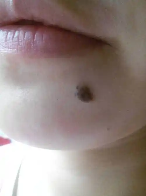 我的左下巴有颗痣 我也为这颗痣很自卑 不想出现在公众面前 特别特别
