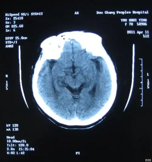 原创颅脑ct片帮忙看看