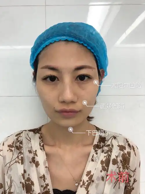 自体脂肪填充面部真实案例,分享一下前后对比照片及恢复过程.