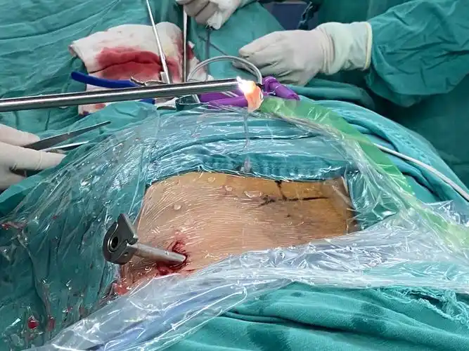 广汉首例外科手术内镜化治疗腰椎间盘突出症