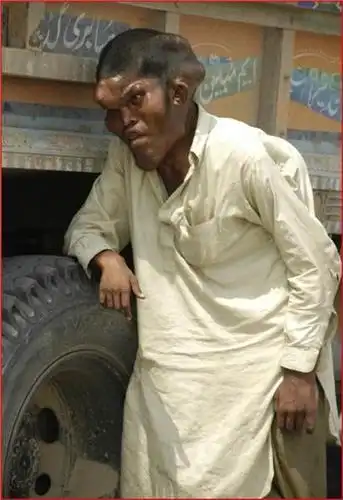 巴基斯坦惊现真实版"象人" 面目凶狠恐怖