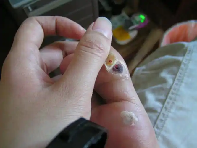 跖疣拔出肉刺图片