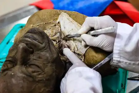 法医学头颈部的法医学解剖解剖照片