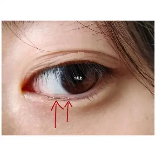 一只眼睛的两根睫毛一直倒睫怎么办啊