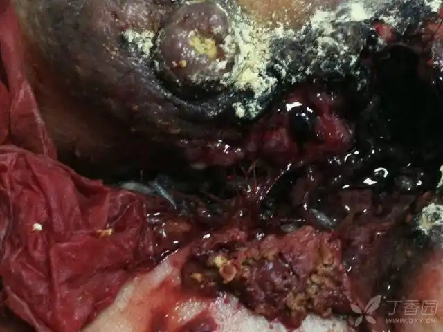 乳房里竟然长了这么多蛆虫 - 普通外科讨论版 -丁香园论坛