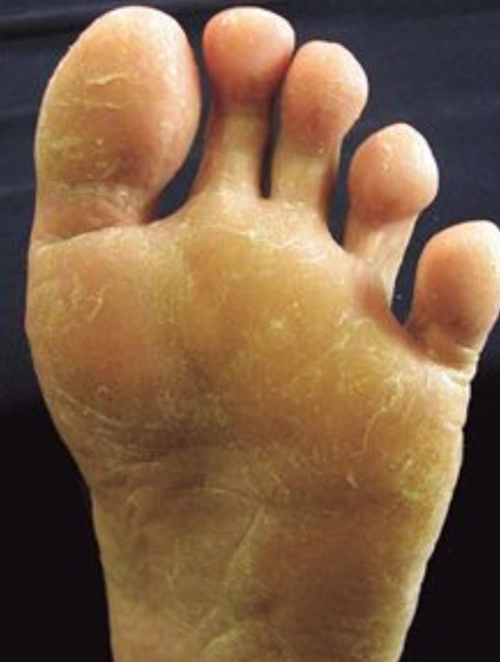 手藓足藓症状图片_有来医生