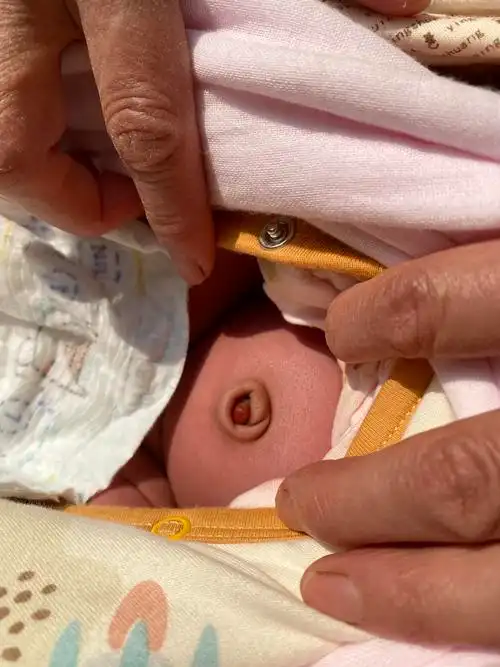 宝宝肚脐掉了之后有一个凸起的肉球,连着消毒了快20