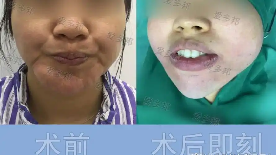 异物取出 ‖ 下巴"活细胞"异物取出,术后效果反馈