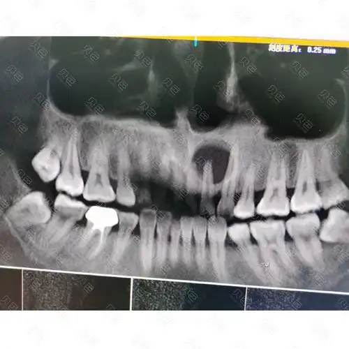 小小年纪根尖囊肿看牙2个多月瘦了10斤拔牙7颗