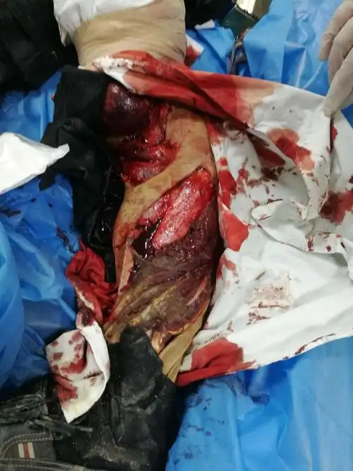 胸部及双下肢严重创伤休克急诊抢救