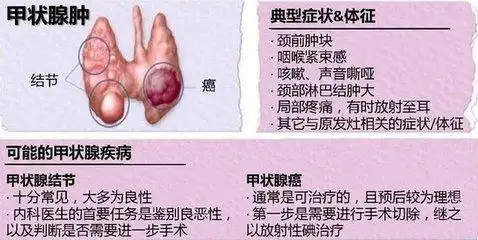 体检发现甲状腺结节,是切还是留?