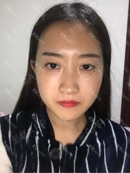 今天是打完瘦脸针的第十天了,确实是从第七天开始见效_圈子-新氧美容