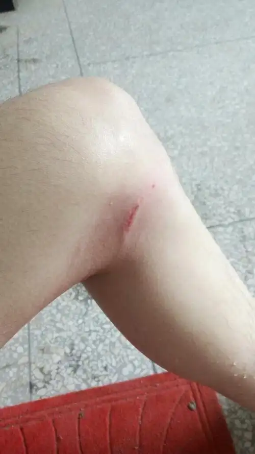 被狗咬了,因为现在医院下班了,2点钟才上班,我还需要对伤口进行什么