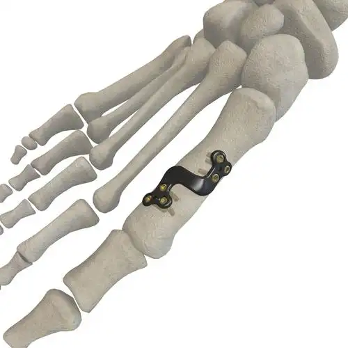 第一跖骨远端截骨钢板