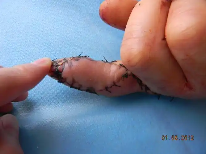 第二掌背皮瓣术后12天