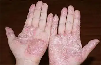 郑州治疗手足癣要多少钱?