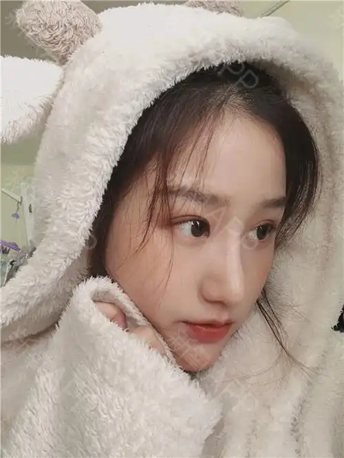 一,单纯l型纯假体隆鼻._圈子-新氧美容整形