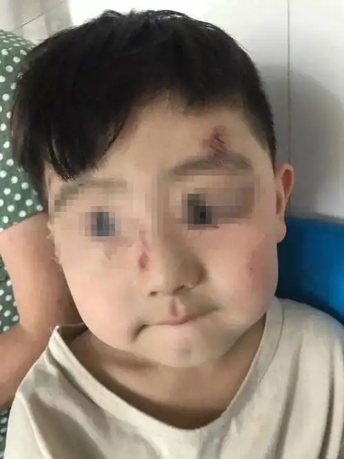 夜晚,焦作博爱路边再次发生小孩摔伤事件.这次是因为.