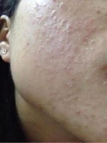 闭合性粉刺怎么去除