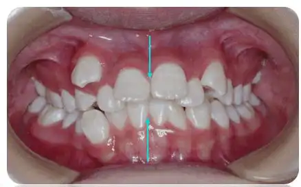 直丝弓矫治伴颞下颌关节单侧髁突囊样骨缺损安氏Ⅱ1类错畸形